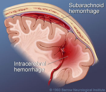 Racial/ethnic differences in outcomes following subarachnoid hemorrhage