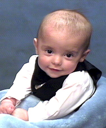 Krabbe Disease
