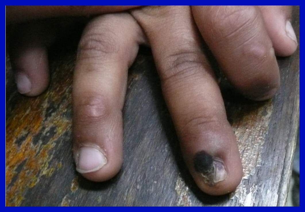 acral lentiginous melanoma