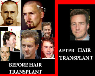 edward+norton+hair+transplant.JPG