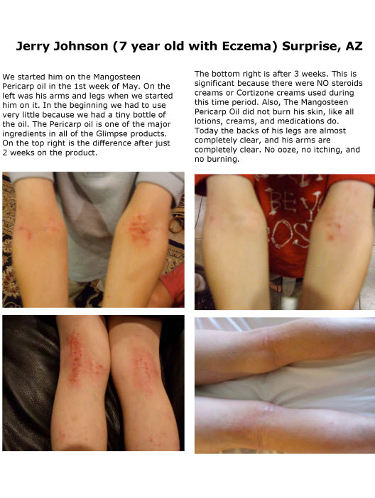 A 7-YEAR OLD'S SUCCESS STORY, USING GLIMPSE FOR HIS ECZEMA!