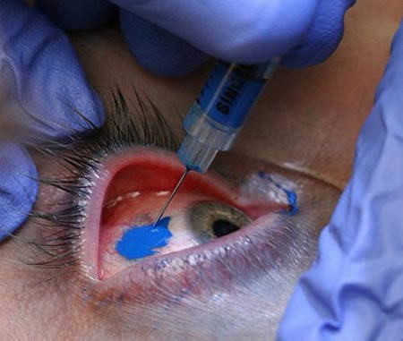 Corneal tattooing is not only possible, but it has been known and done now 