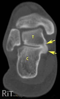 Posterior Calcaneal Spur