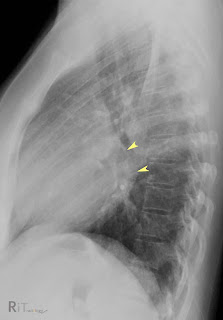 What are the causes of mild left atrial enlargement?