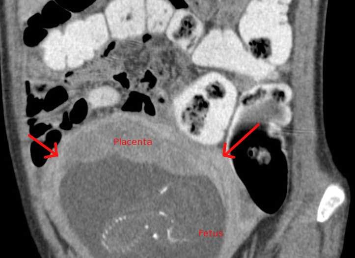 RiT radiology Imaging During Pregnancy What Are the Risks of CT?