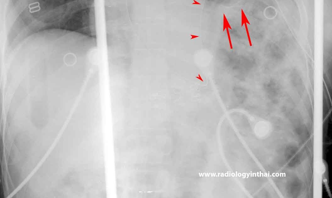 RiT radiology Blunt Diaphragmatic Rupture
