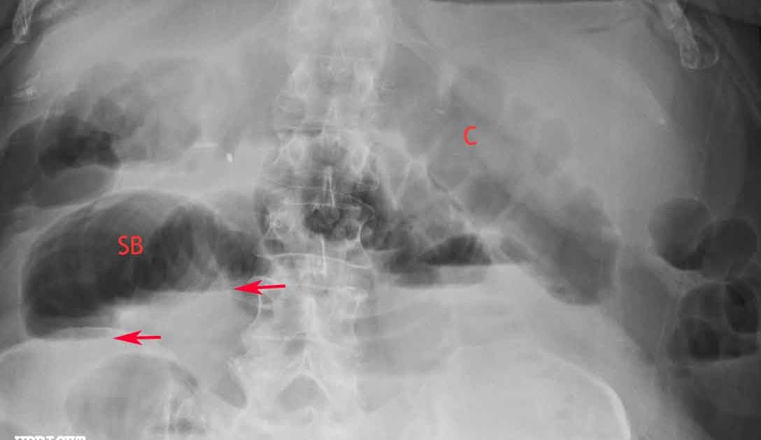 RiT radiology AirFluid Levels at Different Heights in the Same Loop