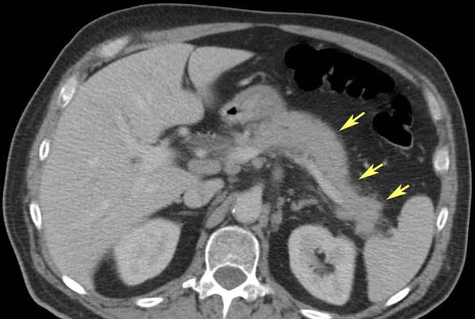 RiT radiology Autoimmune Pancreatitis