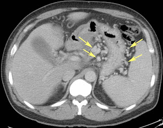 Viagra and portal hypertension Viagra and portal hypertension