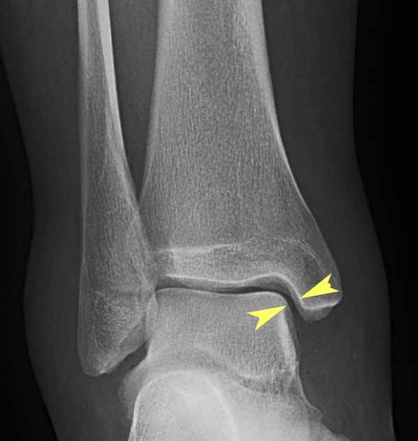 RiT radiology Ankle Mortise Radiographic View
