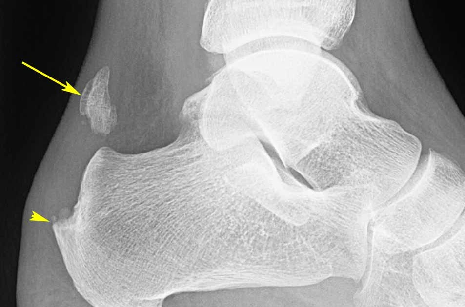 RiT radiology Achilles Tendon Rupture