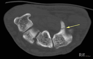 RiT radiology: Hook of Hamate Fracture