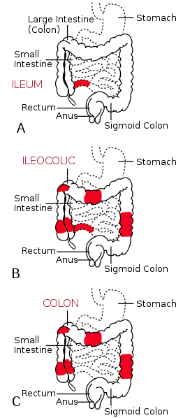 [CrohnsPatterns.png]