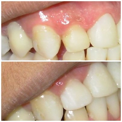 clareamento dentario antes e depois