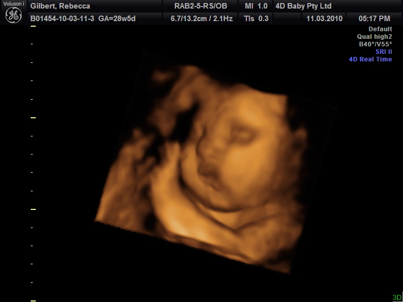 3d ultrasound pictures at 20 weeks. 3D-Ultrasound-2-3-Weeks; 20