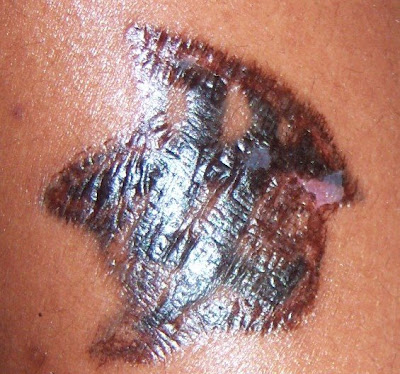 Tca Tattoo Removal Pictures