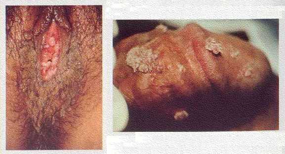 herpes tipo 2