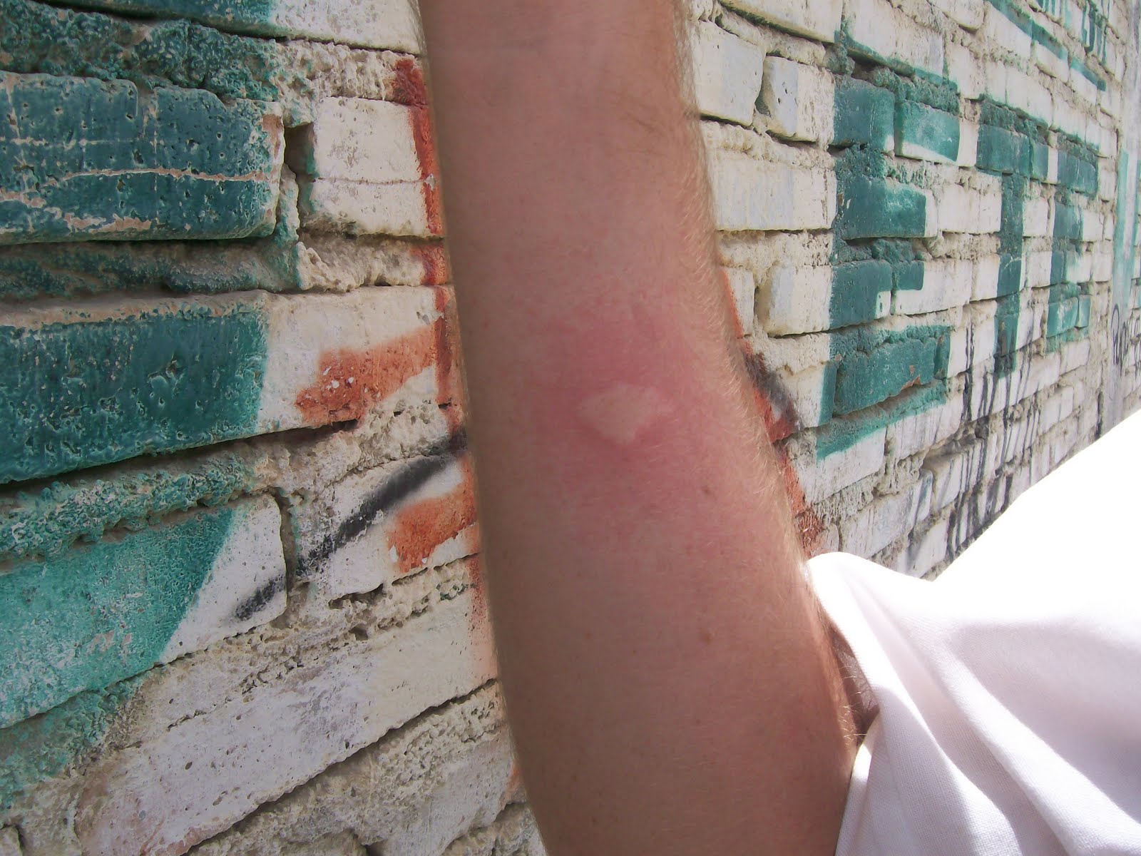 Elder Bret Hansen's Mission Blog Spider Bite Swollen Arm Passing