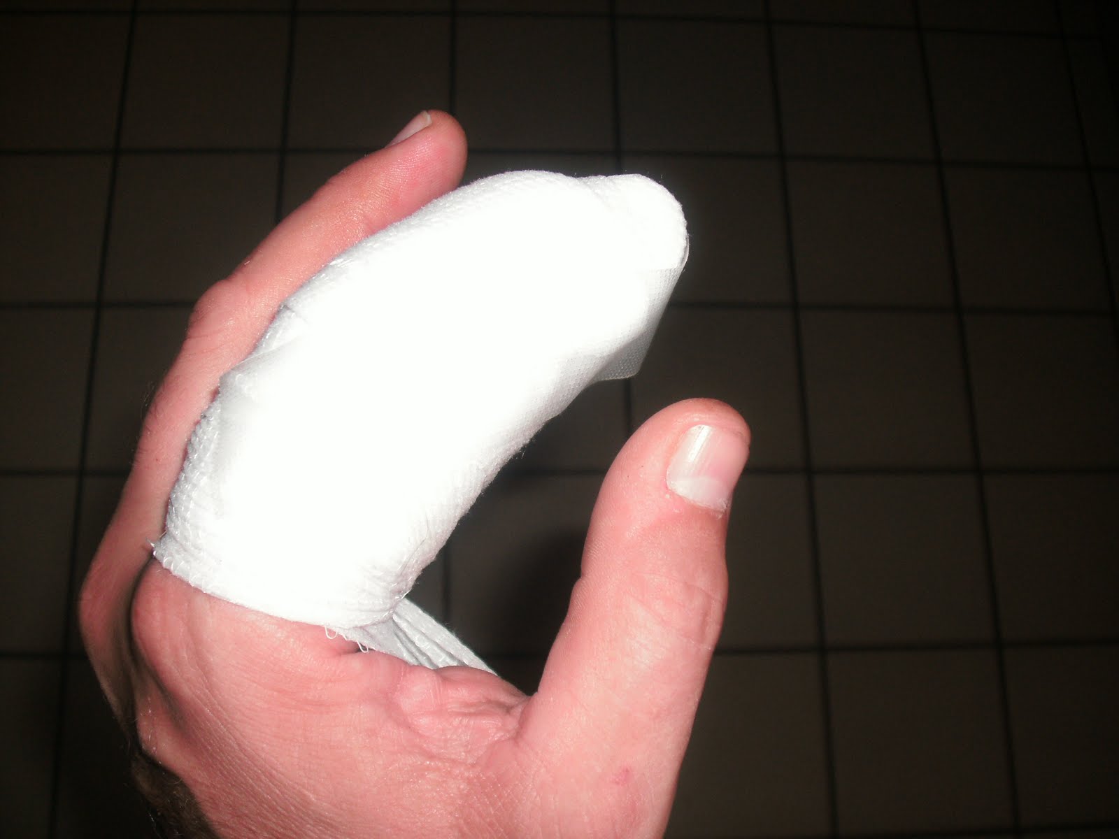 Distal Tuft Fracture