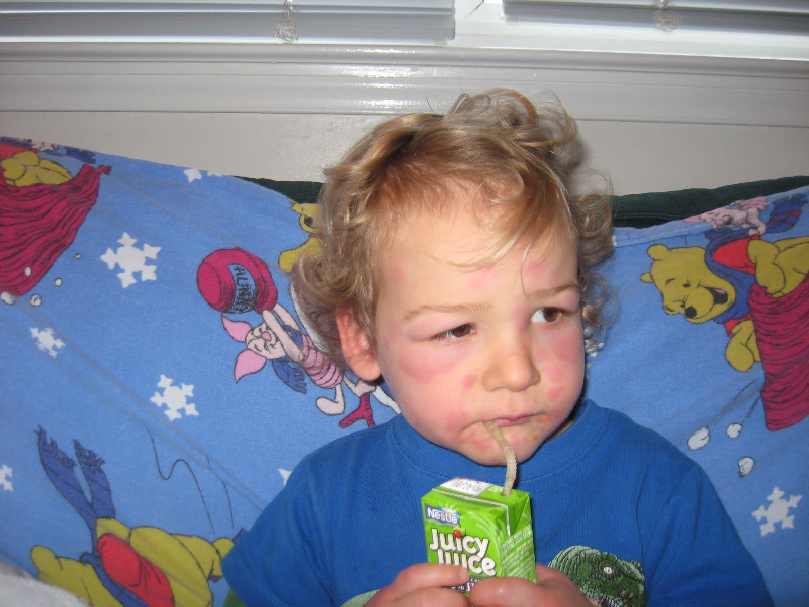 BabIES Kunes Amoxicillin Allergy!