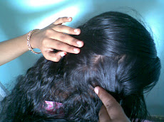 Alopecia Areate- AfterTreatment