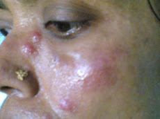 Chronic Recurrent Acne Vulgaris- Before Treatment