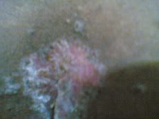 Eczema-Before Treatment