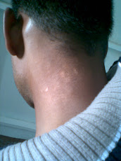 Leucoderma - After Treatment
