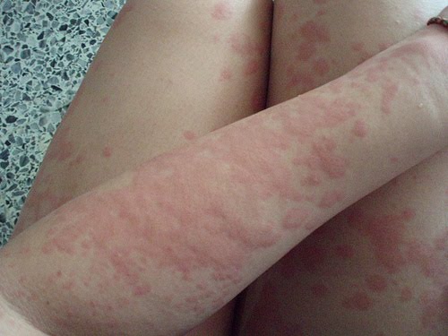 mild poison sumac rash. mild heat rash pictures. mild