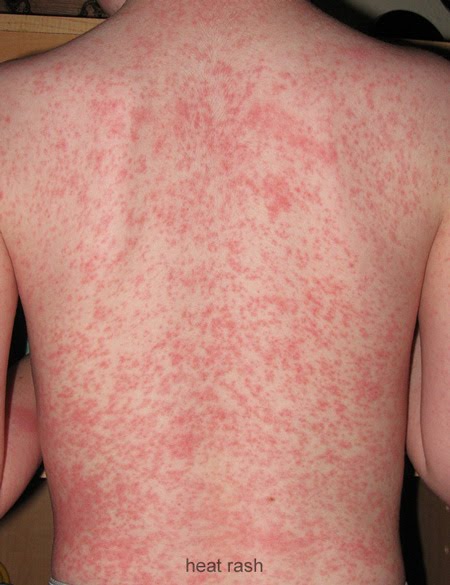 infant heat rash pictures. heat rash on hands. heat rash