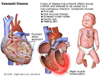 FAQ on Kawasaki's Disease