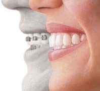 Invisalign Care