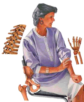 http://2.bp.blogspot.com/_gsiPv7cjMDg/SSs-gdpra8I/AAAAAAAAA-8/BTVXZa8Df5o/s400/osteoporosis11.gif