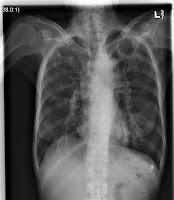 Cavitary Lung Lesion