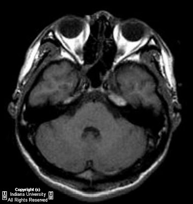 Brain Capillary Telangiectasia