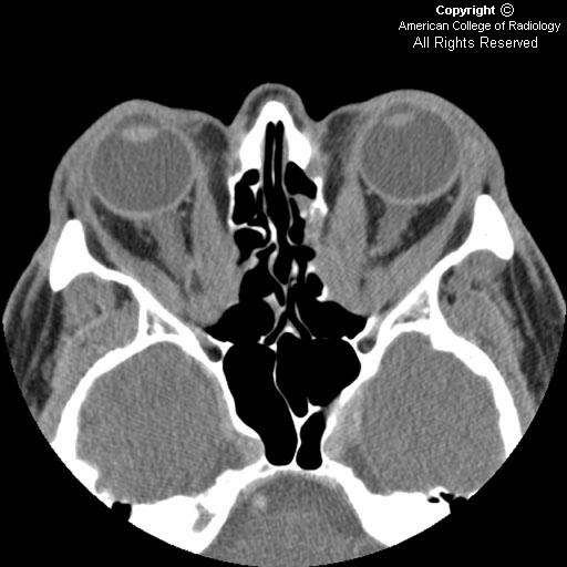 Neuroradiology On the Net Graves ophthalmopathy