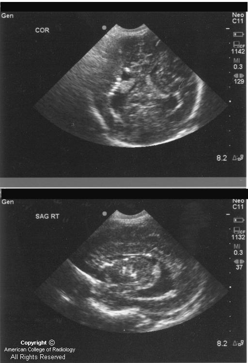 Neuroradiology On the Net Congenital Cytomegalovirus infection