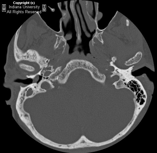 Cholesteatoma+histology