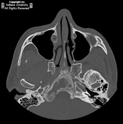 Neuroradiology On the Net: Monostotic clival fibrous dysplasia