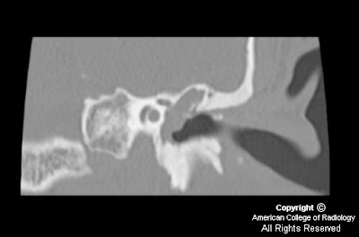 Cholesteatoma+on+mri