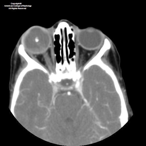Neuroradiology On the Net Retinoblastoma with recurrence following
