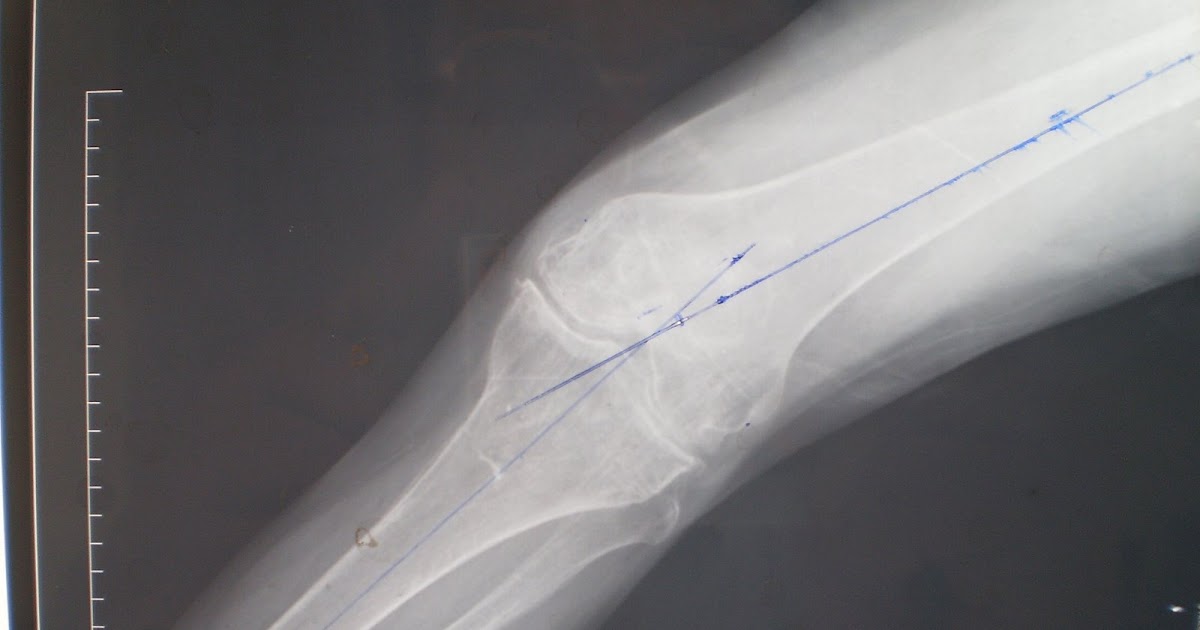 joint care foundation Knee Joint Arthritis