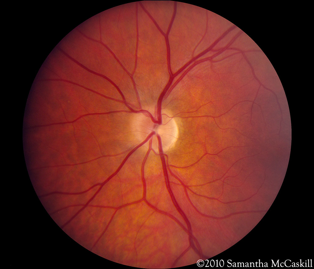 Optic Neuritis Natural Cure Optic Neuritis Natural Cure