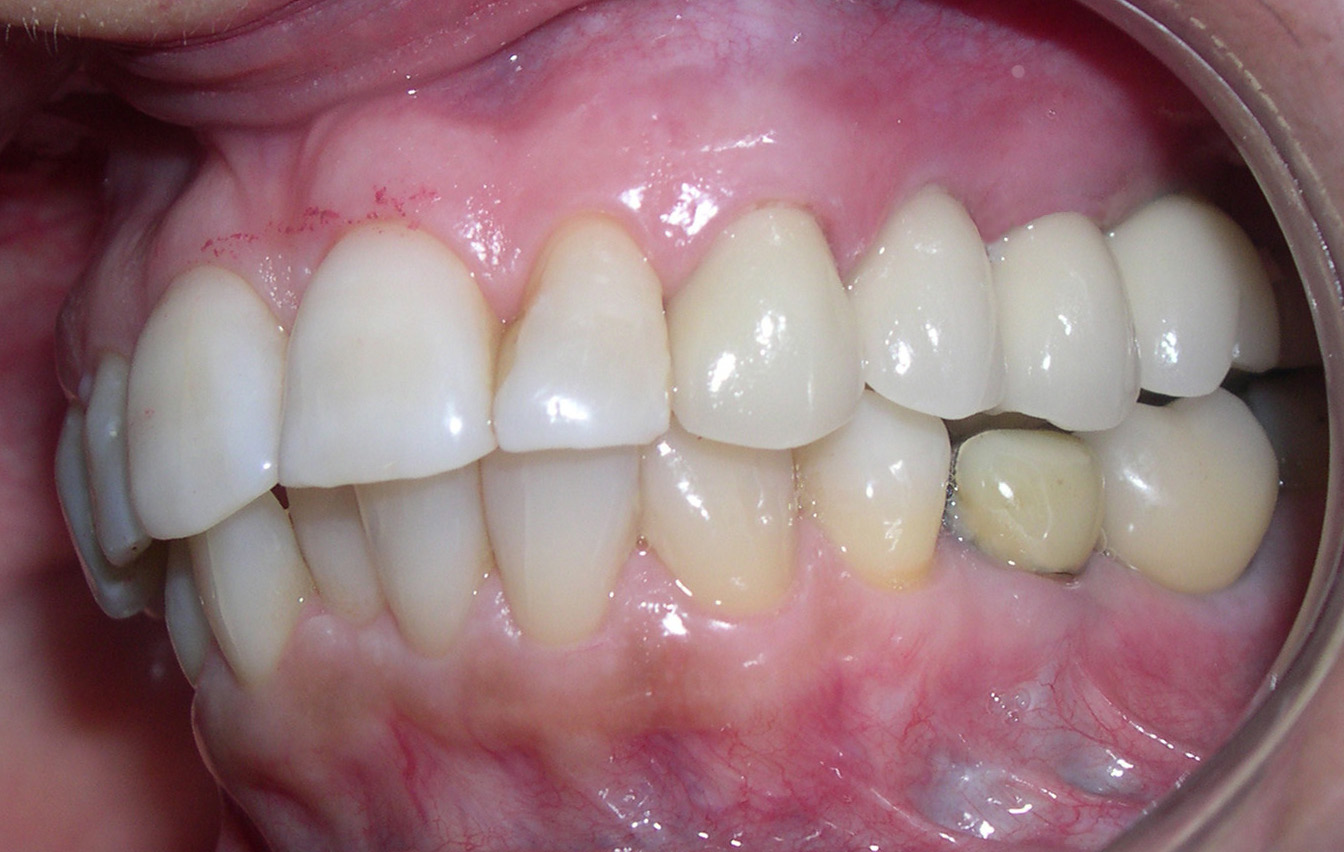 Brazilian Dental Community Onde estão os dentes naturais, as coroas