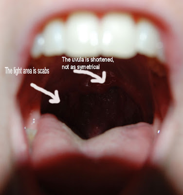 pockets in tonsils