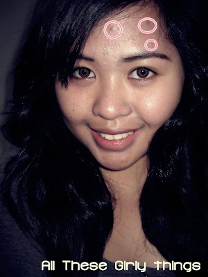 Whiteheads On Forehead