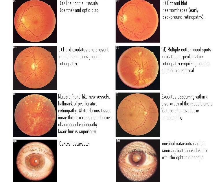 normal retina vs diabetic retinopathy normal retina vs diabetic retinopathy