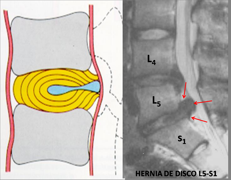 La hernia sheynogo del departamento sobre los rayos X