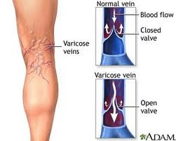 Healthy study cases - Why Varicose Appear