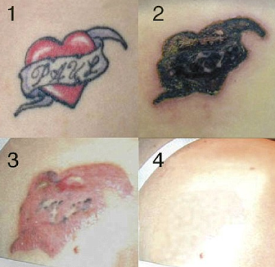 Rejuvi Tattoo Removal